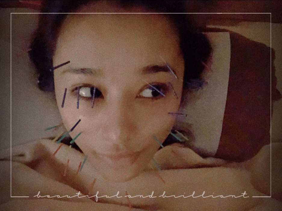 高橋メアリージュン、顔じゅう美容鍼だらけの“ハリネズミshot”公開に反響サムネイル画像!